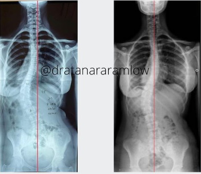 Saiba mais sobre o tratamento para escoliose